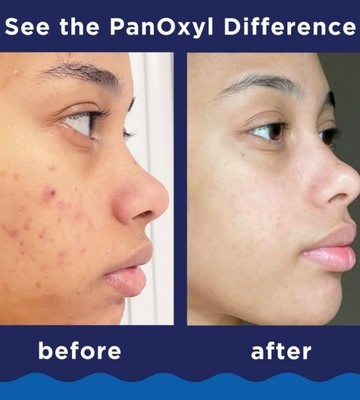 PanOxyl Acne Foaming Wash